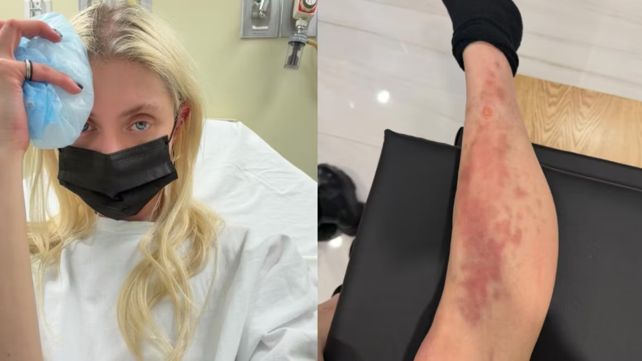 Taylor Momsen a &eacute;t&eacute; hospitalis&eacute;e apr&egrave;s avoir subi une grave r&eacute;action allergique suite &agrave; une morsure d'araign&eacute;e.